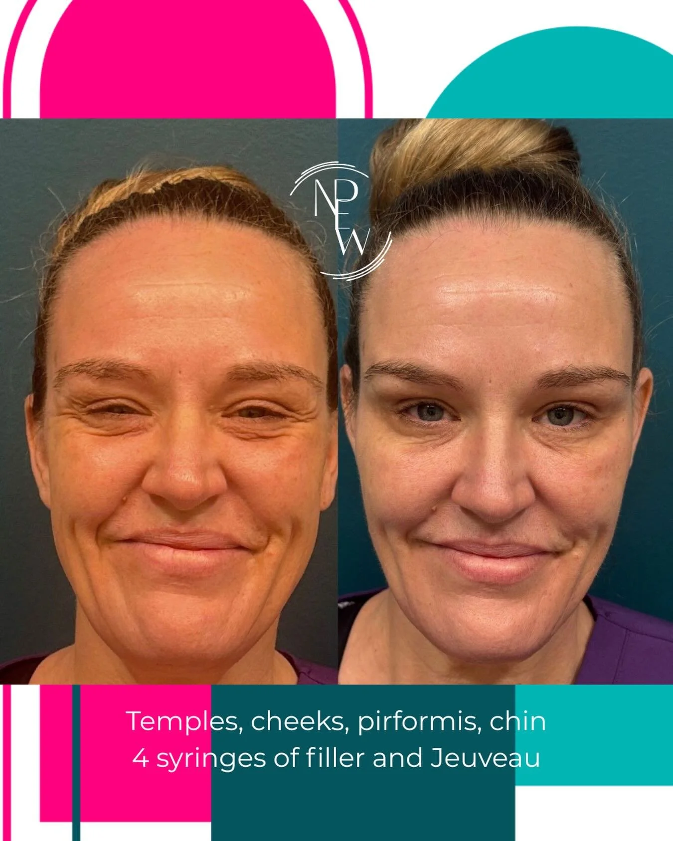 Full Face Rejuvenation
Artist - NP Sarah Sanchez
Tools used - Needle and Cannula
Areas treated - cheeks, temples, pirformis, chin
4 syringes of Evolysse FORM Filler
Jeuveau 44 units tox- no forehead tox

Patient requested a more refreshed look for he