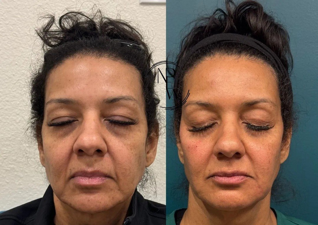 Filler is not a one-and-done fix.

The best results often come from patience, planning, and small, strategic changes over time ✨

This patient&rsquo;s progress is 3 years apart.

That&rsquo;s what trust the process actually looks like.

Less puff.
Mo