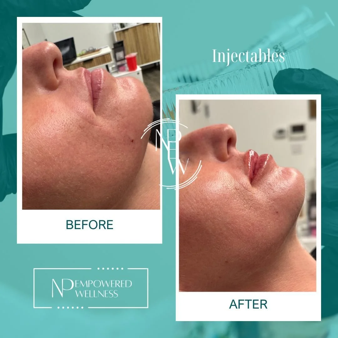 Artist: NP Sarah
Product: RHA2
Instrument: Needle

Luscious Lips &mdash; Before &amp; After
Subtle enhancement designed to shape, define, and restore balance&mdash;without overfilling.
#lipfiller

NP Empowered Wellness
inside W Salon Suites
1917 Doug