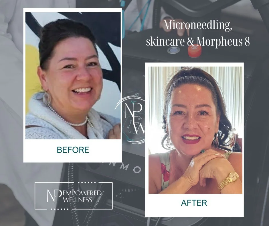 Don't want Botox or Fillers? You still have options ✨

These results were achieved with collagen-stimulating treatments like Morpheus8, microneedling, chemical peels, and IPL &mdash; focused on improving skin quality, texture, tone, pores, fine lines