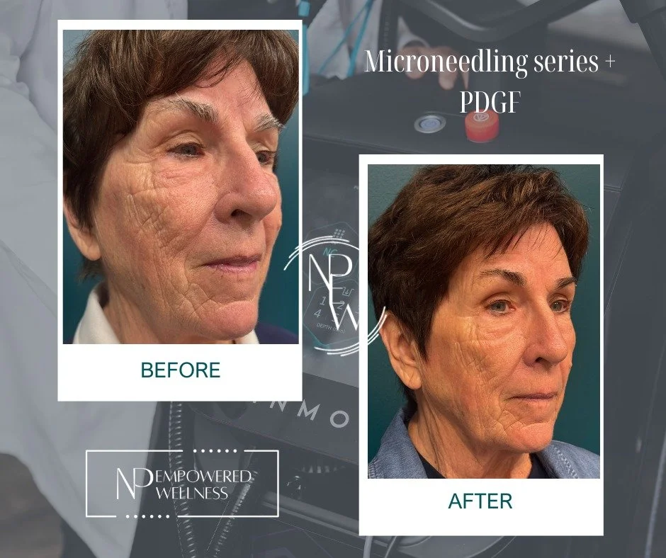Not every patient is a candidate for RF treatments &mdash; and that&rsquo;s why customized treatment plans matter. ✨

This patient was unable to undergo radiofrequency treatments, so we created a personalized skin rejuvenation plan using Microneedlin