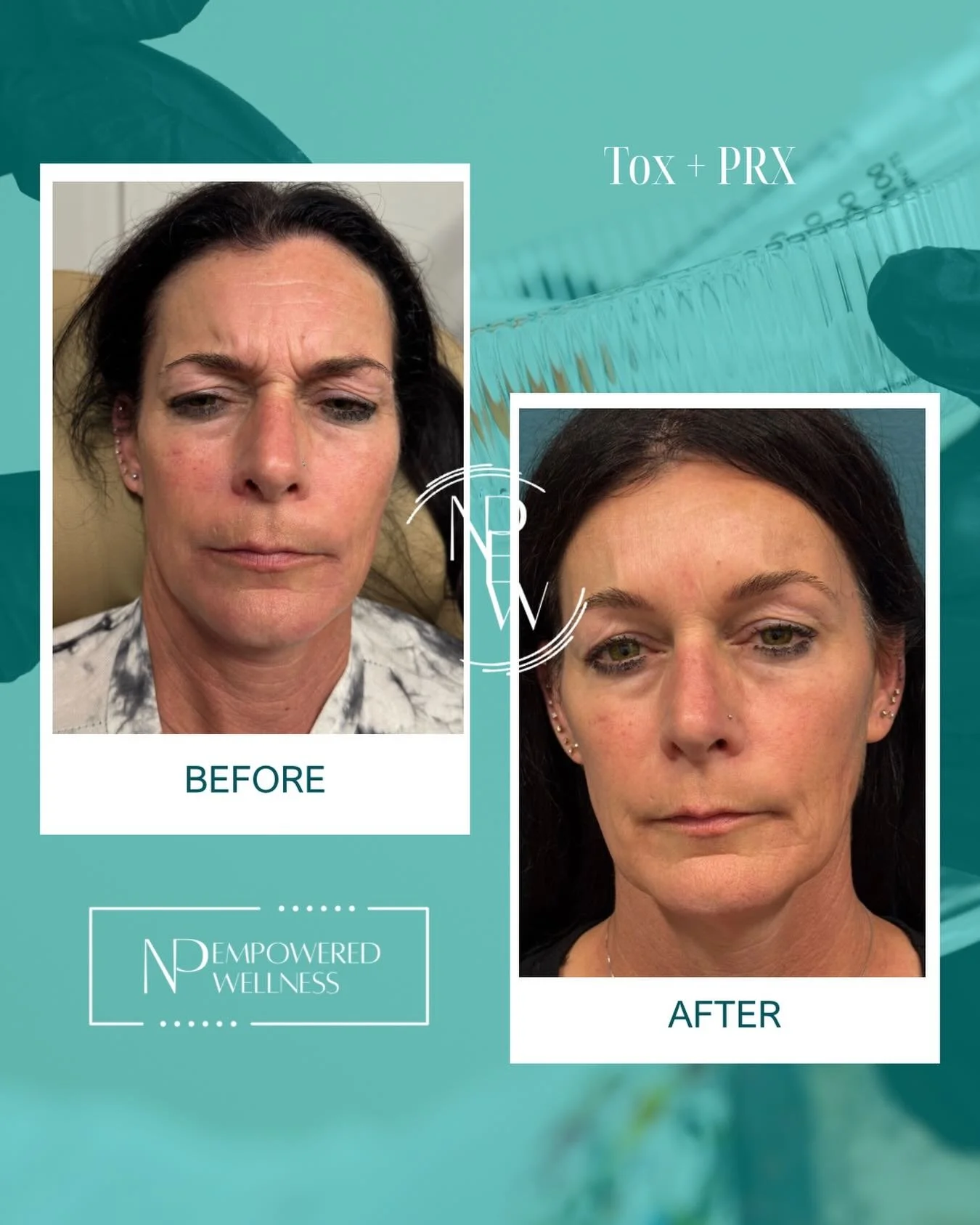 Combination therapy for the win with no 11s here ✨

This lovely patient is a #member and  started her customized skin rejuvenation journey with PRX + tox, and these are only her FIRST results. 👏

By combining treatments strategically, we&rsquo;re ab