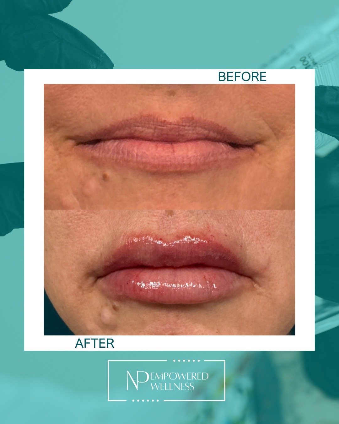 Artist: NP Sarah
Instrument: Needle
Product: Evolus Form
Masterpiece: Soft, luscious lips 💋

She wanted luscious lips&mdash;and we took our time to get them just right. ✨

This result took two sessions, and that&rsquo;s completely okay. Beautiful li