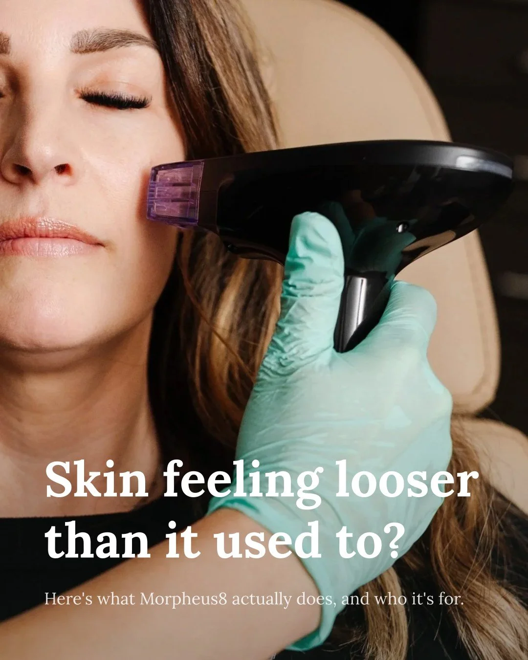 Skin laxity is one of the most common concerns I hear in the treatment room, and one of the least well understood.

Morpheus8 combines microneedling with radiofrequency energy to tighten skin and address laxity at a deeper level than surface treatmen