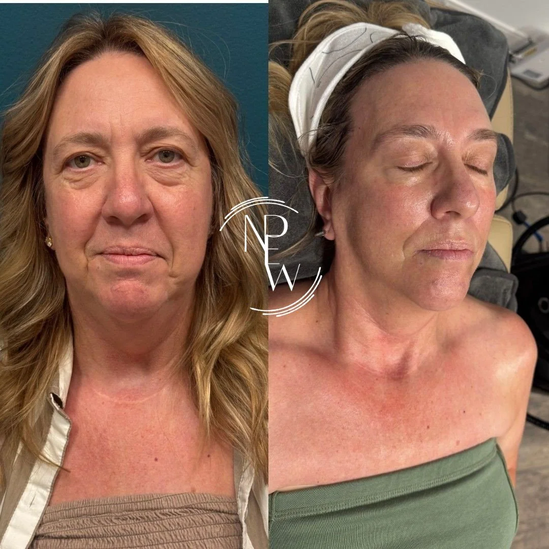 This transformation was built with patience, intention, and the right timing.

Her personalized plan included a series of #PRX treatments,  one IPL session. and microneedling with exosomes and adding skincare. We waited for the right season and worke