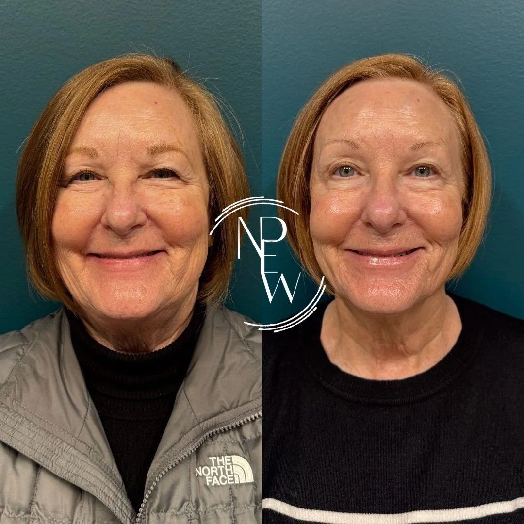 **ONE YEAR IN THE MAKING.**

This before and after is what happens when we stop chasing quick fixes and build the whole CAKE.

This transformation included:

🍰 Medical weight management to support the foundation
🍰 Morpheus8 for collagen, firmness, 