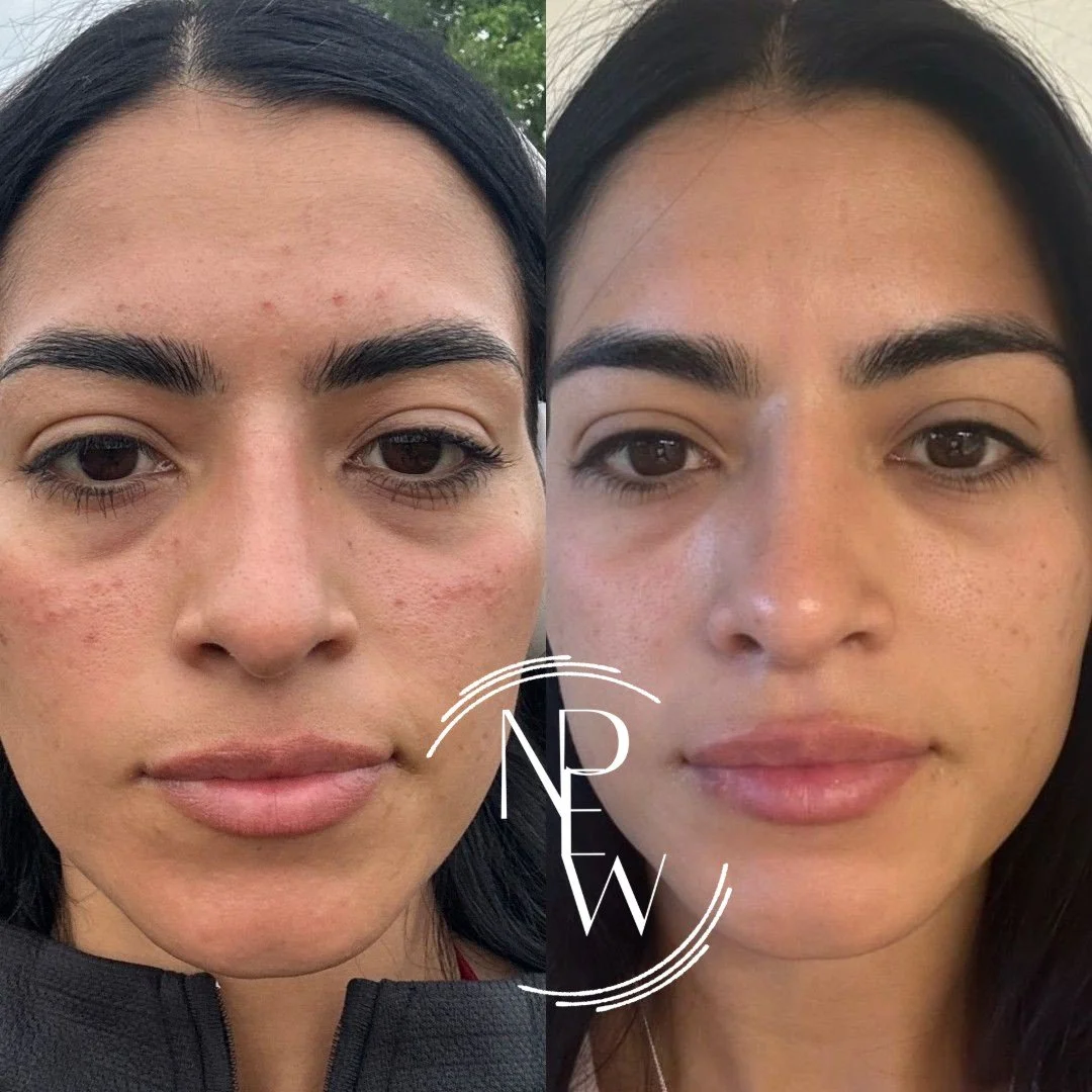 No filler. Just a plan.

This before + after is after 12 weeks of consistent EPICUTIS skincare + two PDGF treatments under the eyes.

The goal wasn&rsquo;t to change her face&mdash;it was to improve the **quality, hydration, and overall appearance of