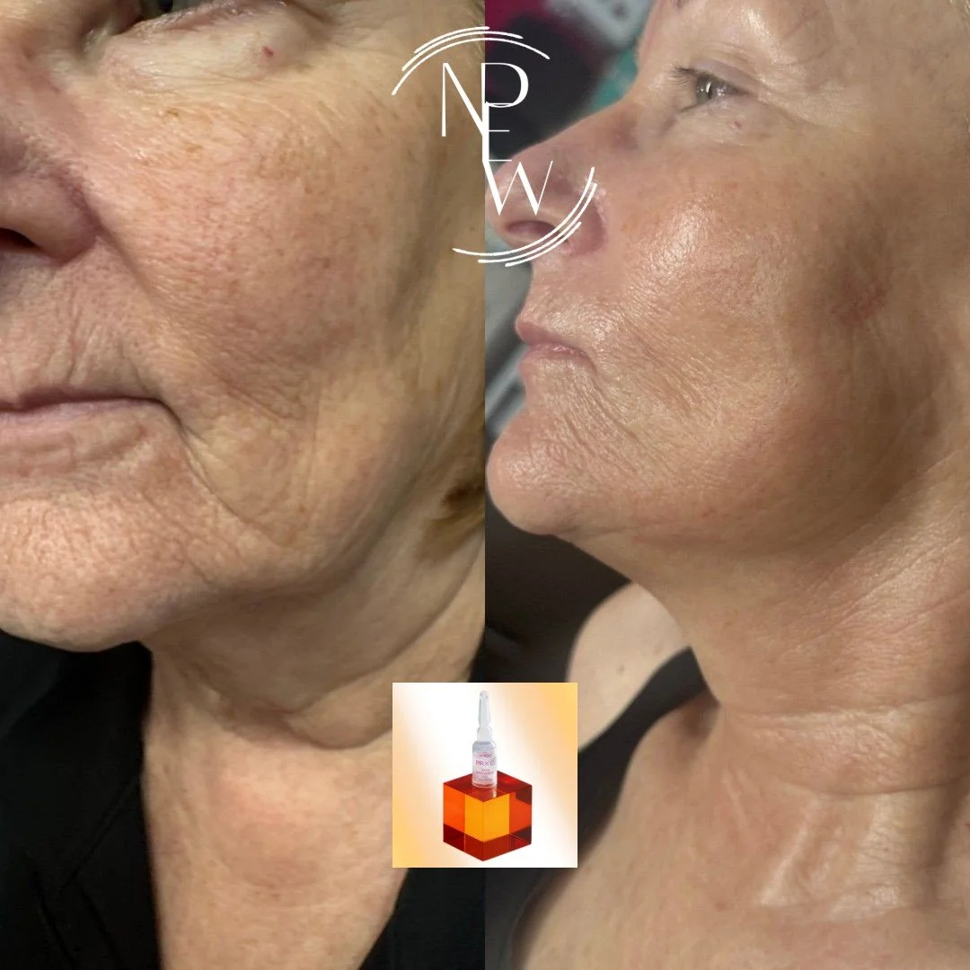 PRX-C can be transformative&mdash;and it is the perfect little sprinkle before a special event. 🍰

This before and after shows brighter, smoother, more refreshed-looking skin without the heavy peeling or downtime many people expect.

PRX-C is not ju