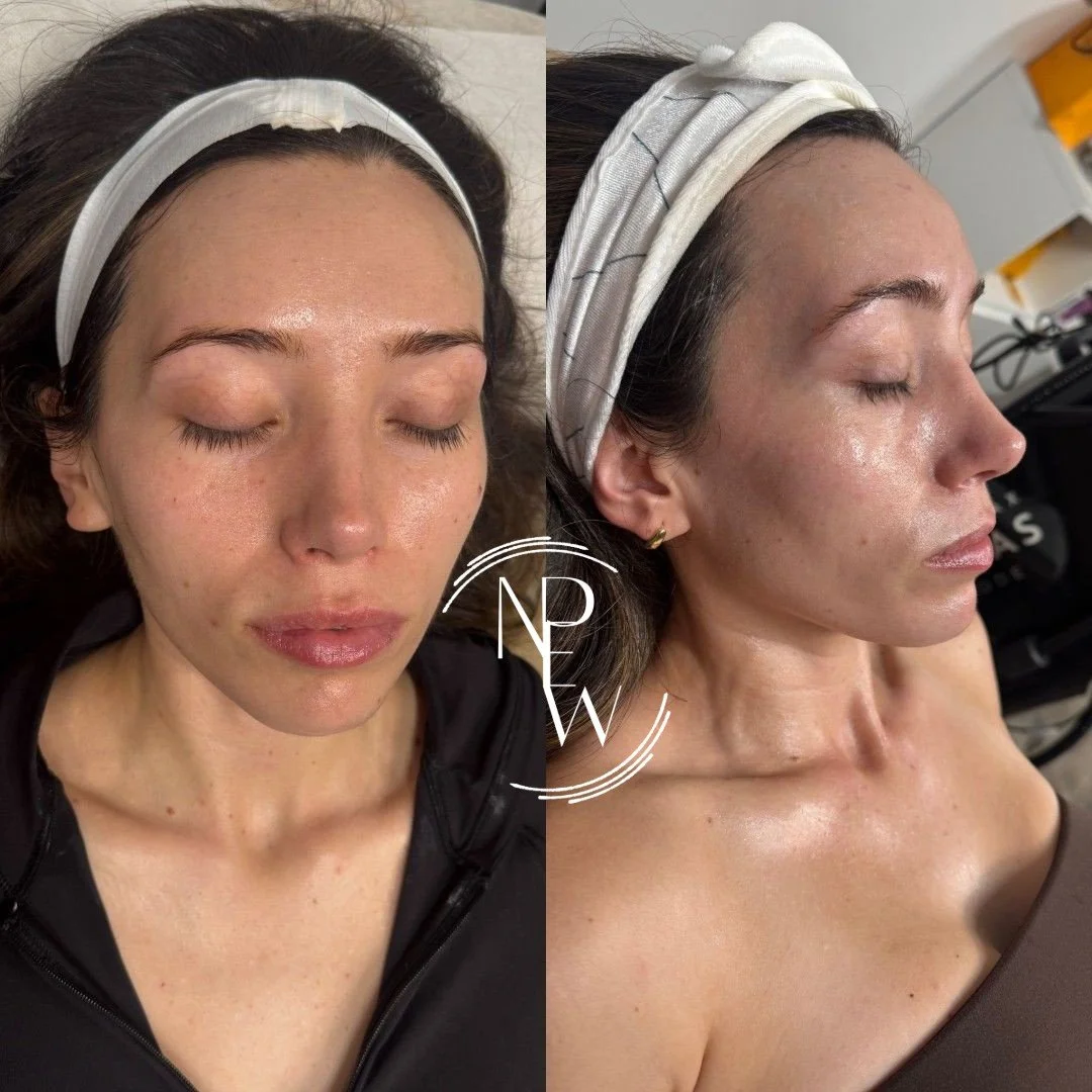 Before and after a few PRX treatments....and look at that glow! 

No Downtime!
No Needles!

This beauty needed no adjustments. We simply supported her skin and let her natural beauty shine through.

Stronger Body. Healthier Skin. Longer Life.

#NPSar