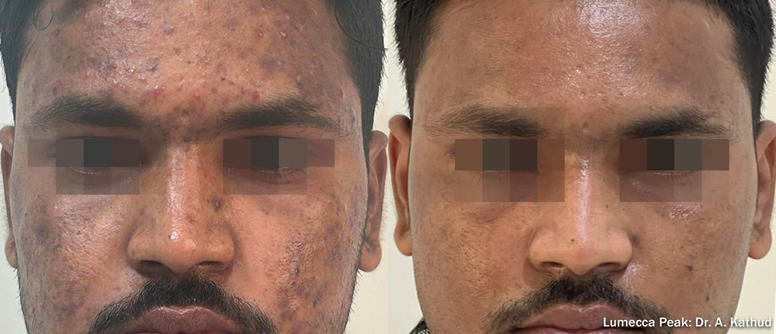 sundamage ipl roseville