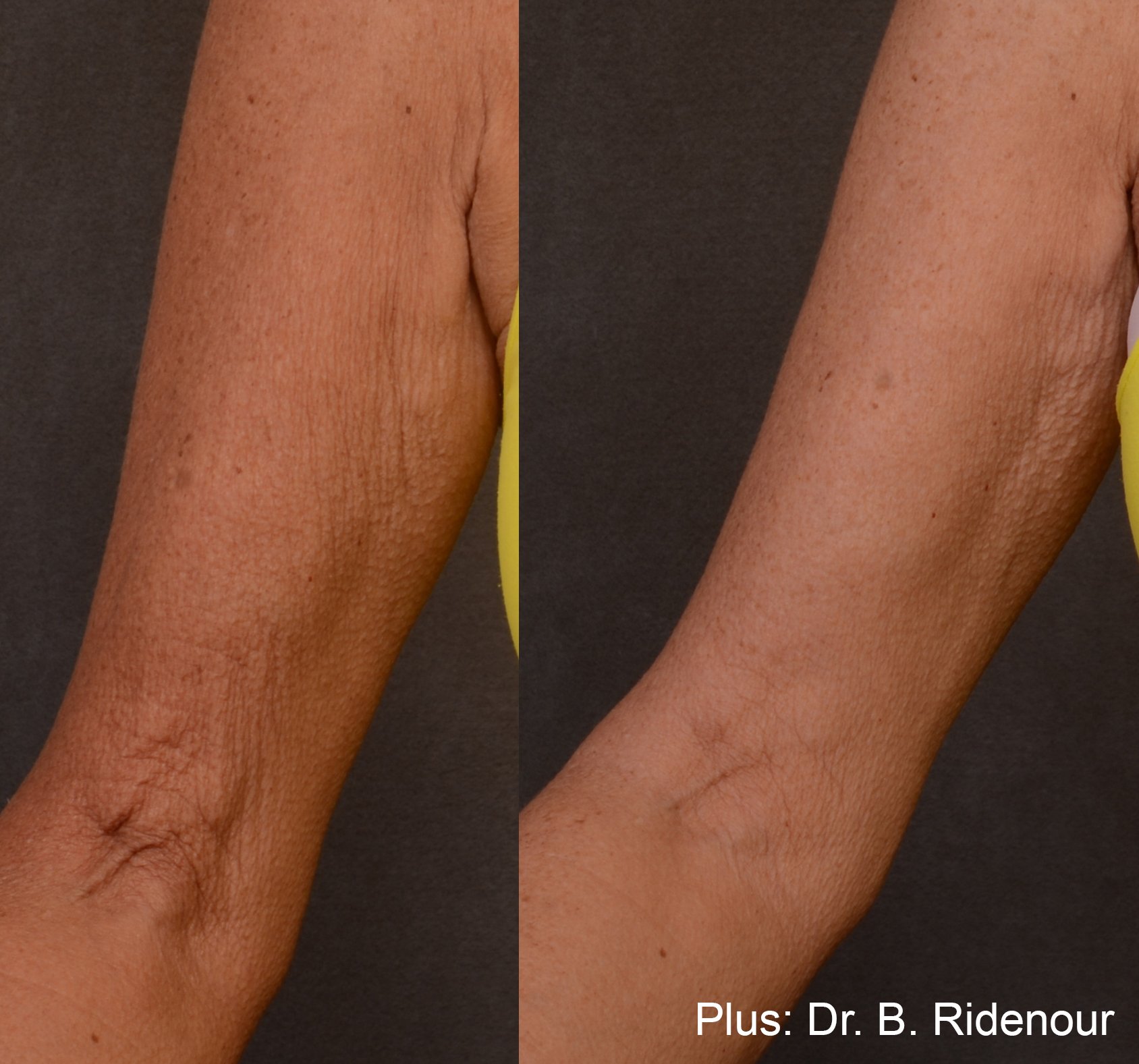 plus-before-after-dr-b-ridneour-preview-1.jpg