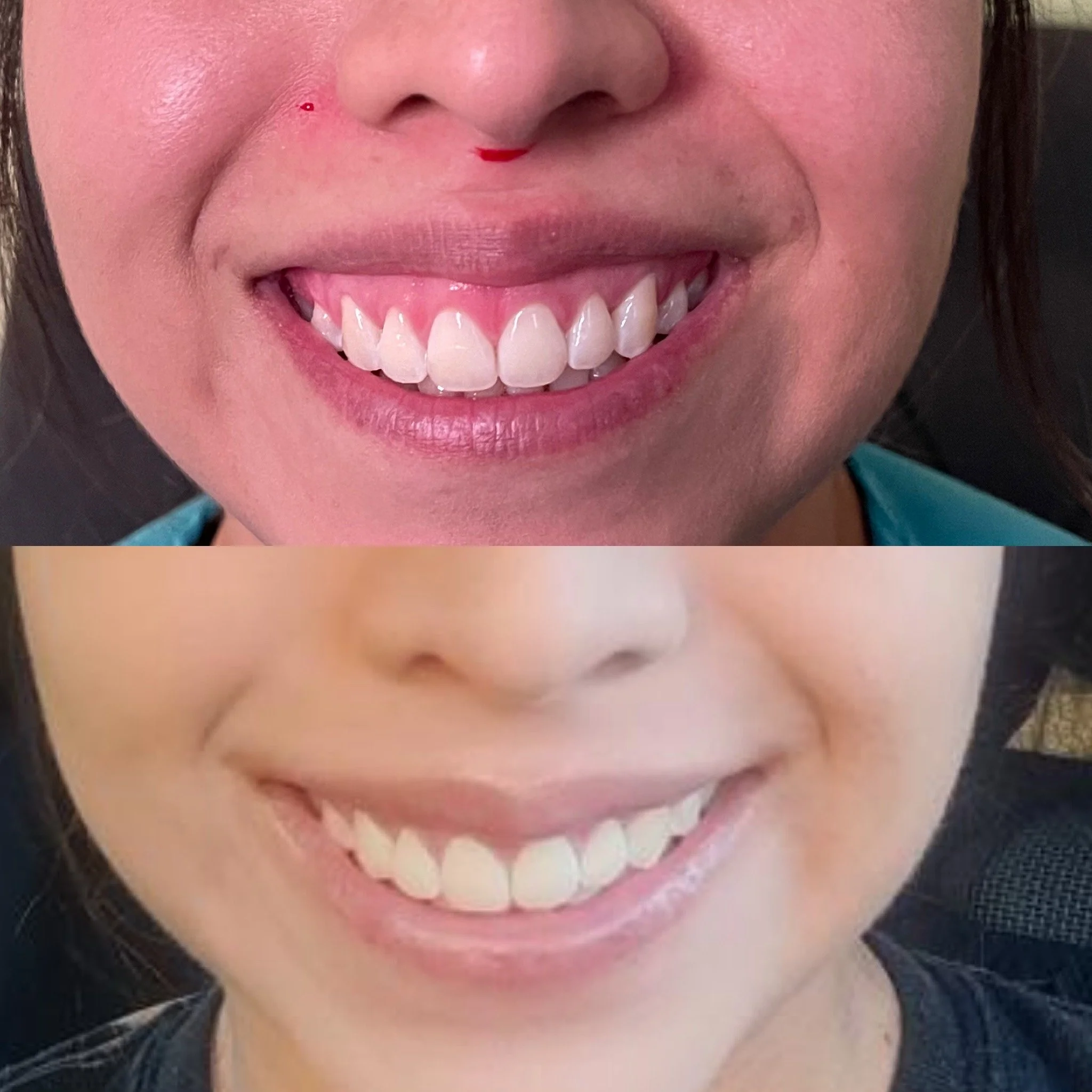 gummysmile xeomin.JPG