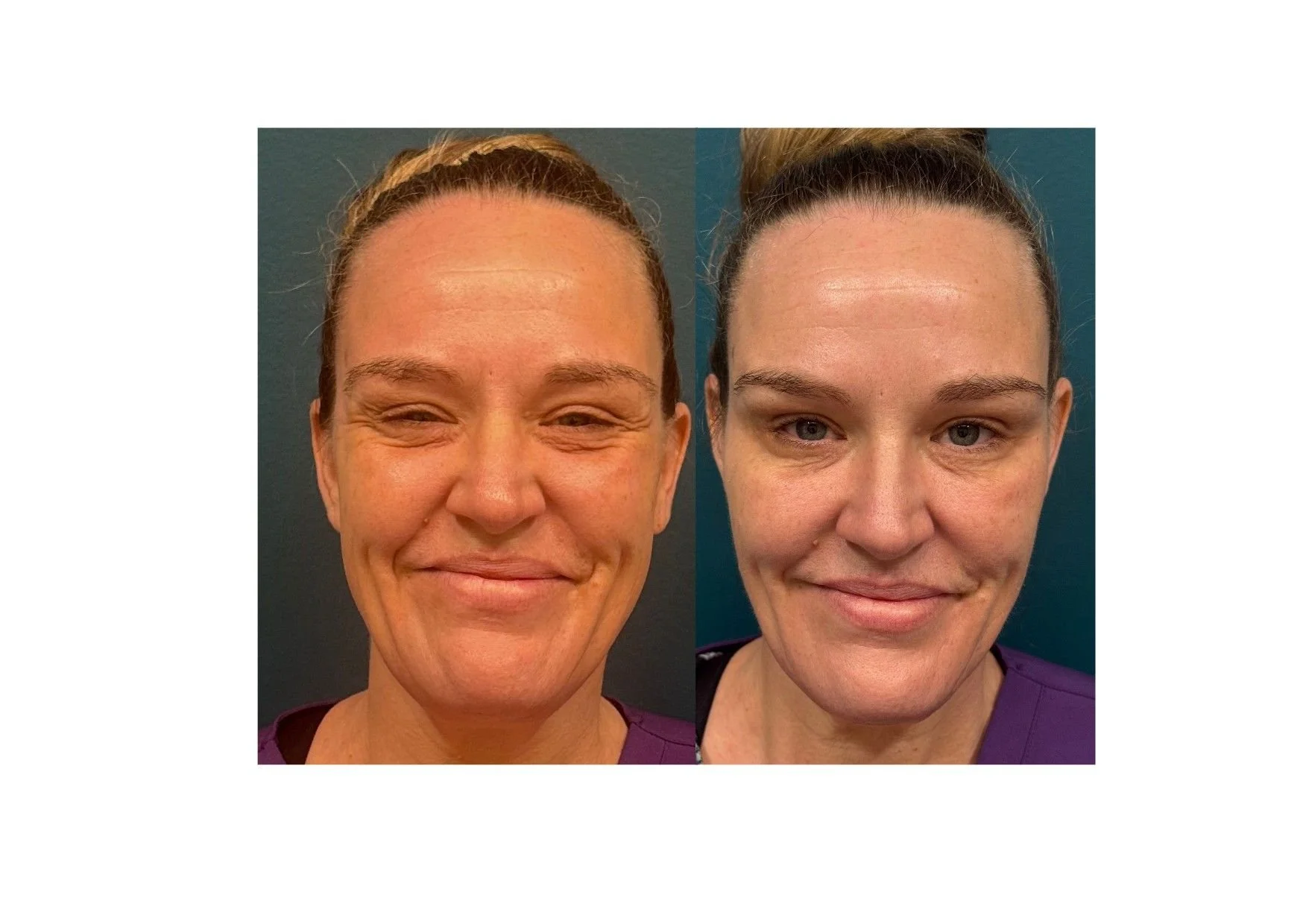 Before and after images of a woman showing facial improvement, smiling in both.