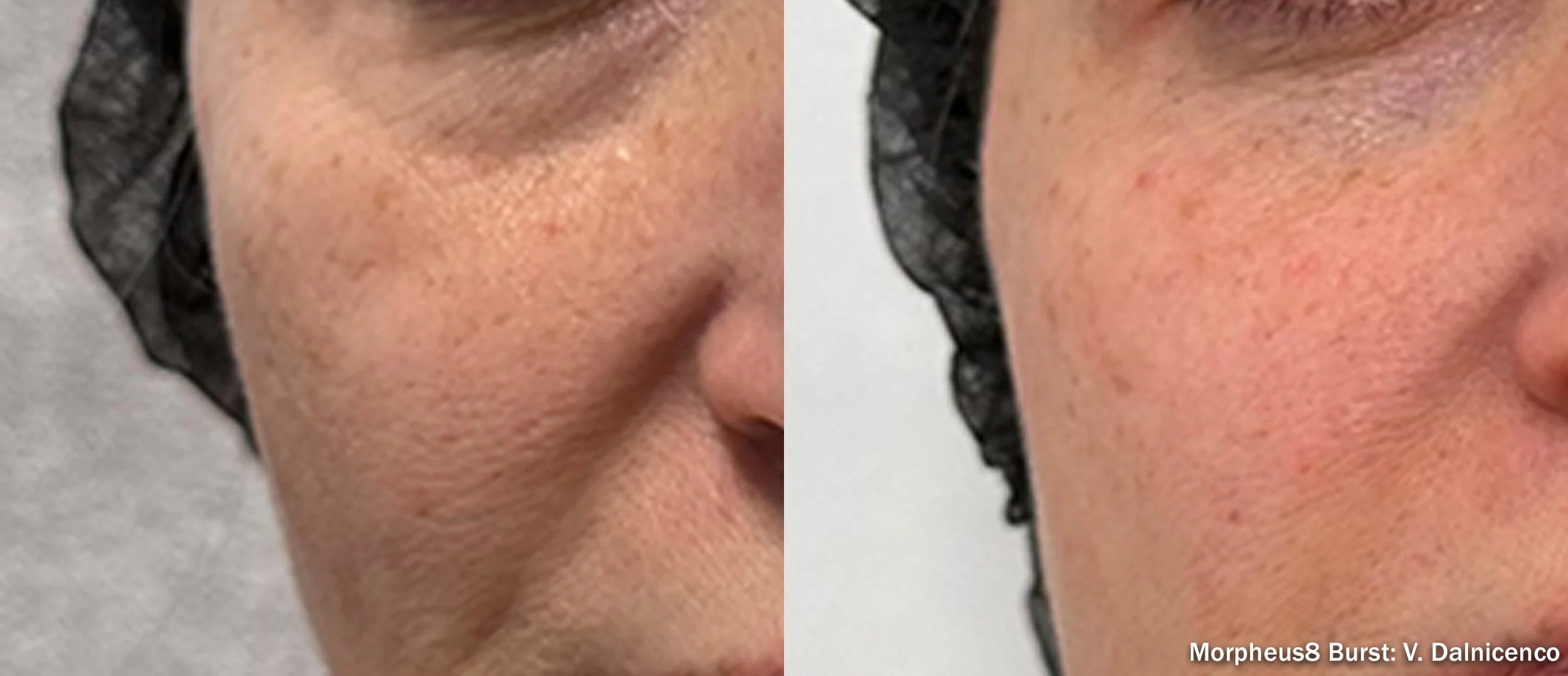 medical spa nlf treatment