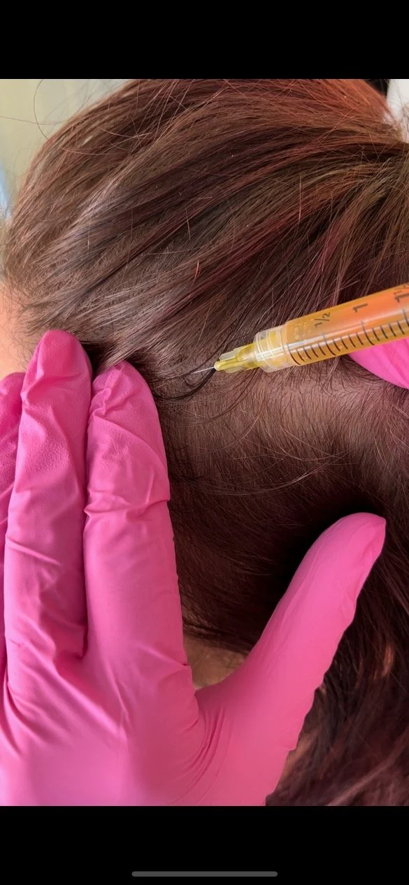 Close-up of a person receiving a hair injection with a syringe, wearing pink gloves, with brown hair and the injection near the scalp.