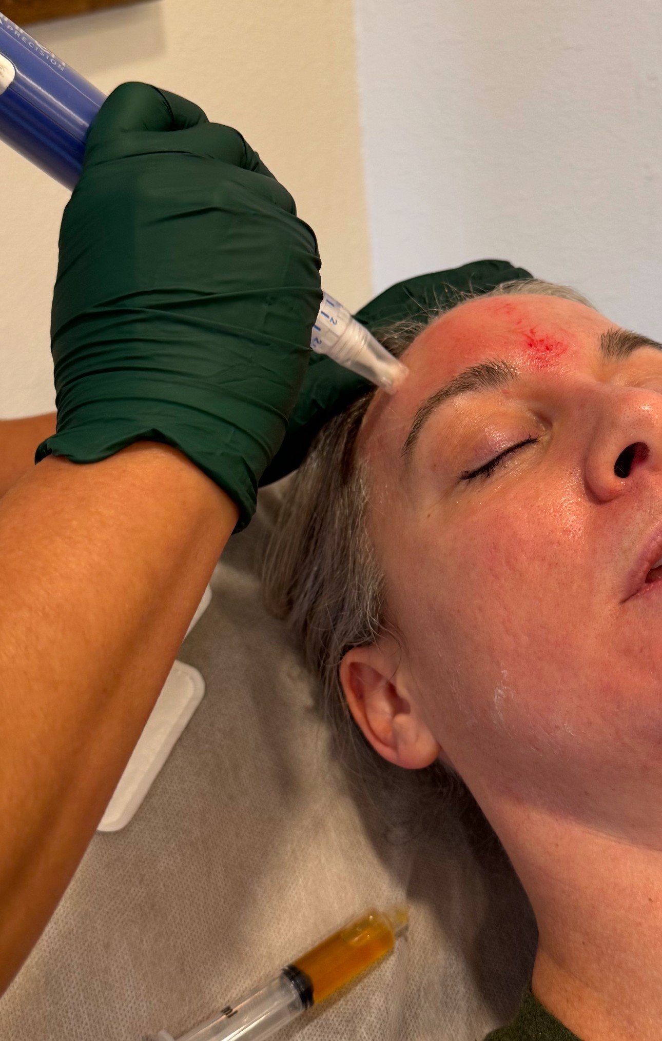Person receiving microneedling procedure on forehead with syringe and gloved hand