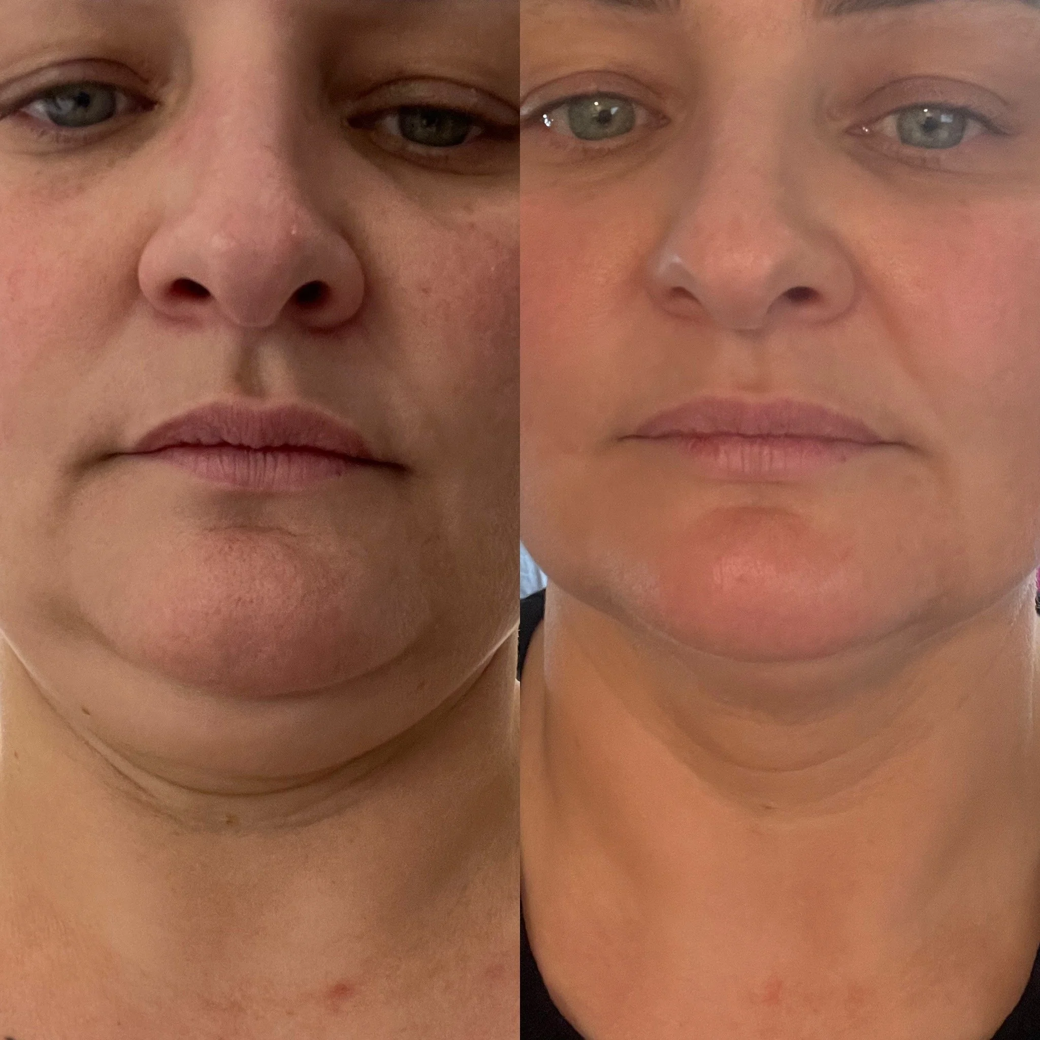 kybella 2 vials .JPG