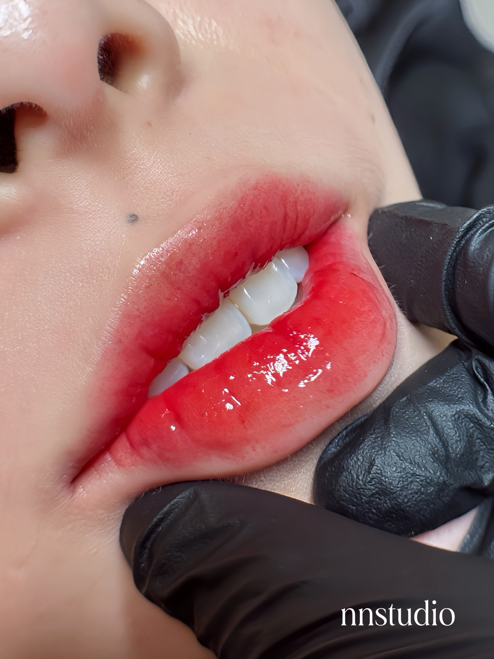 Nano lips before and after singapore