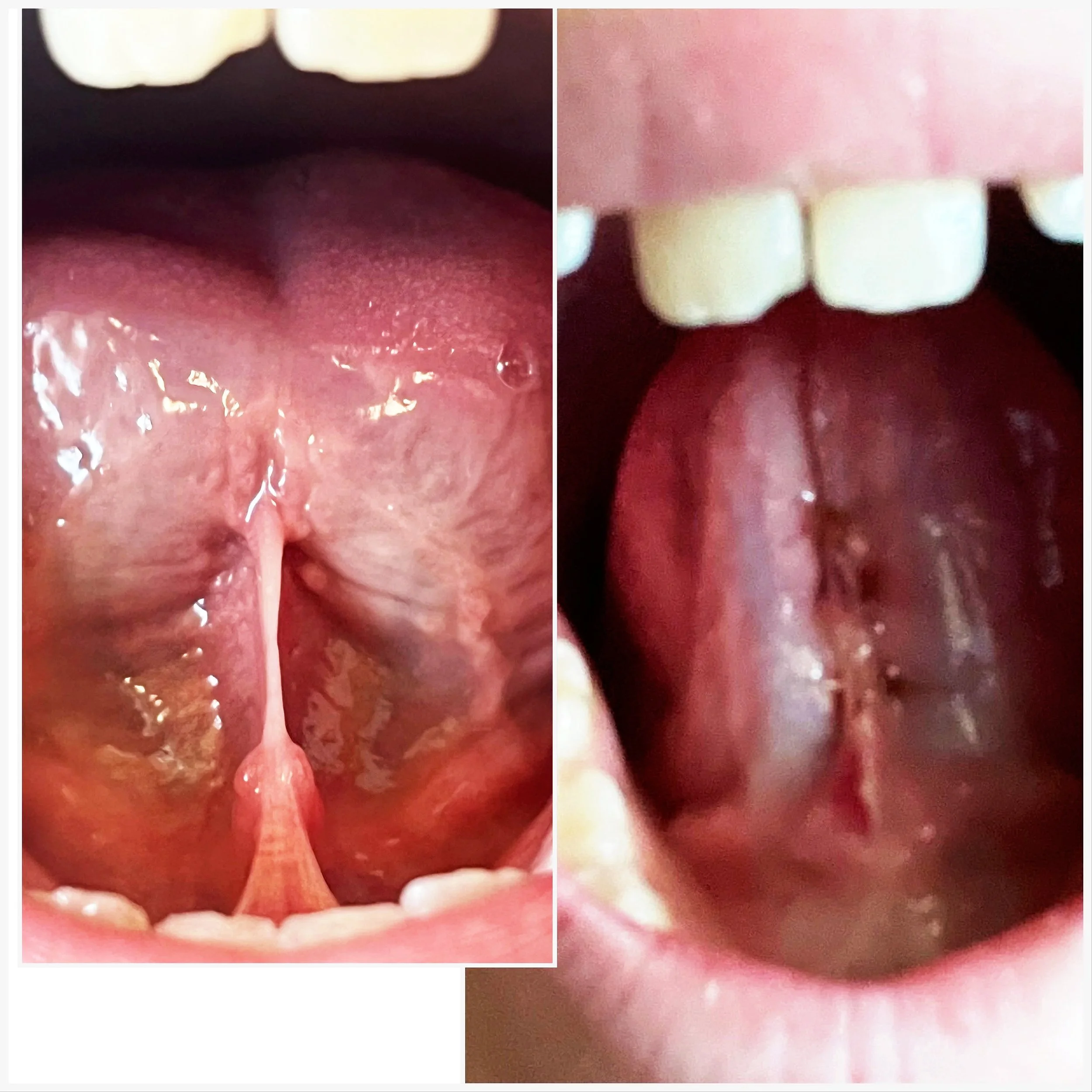Why Follow-Up Matters After a Tongue Tie Release