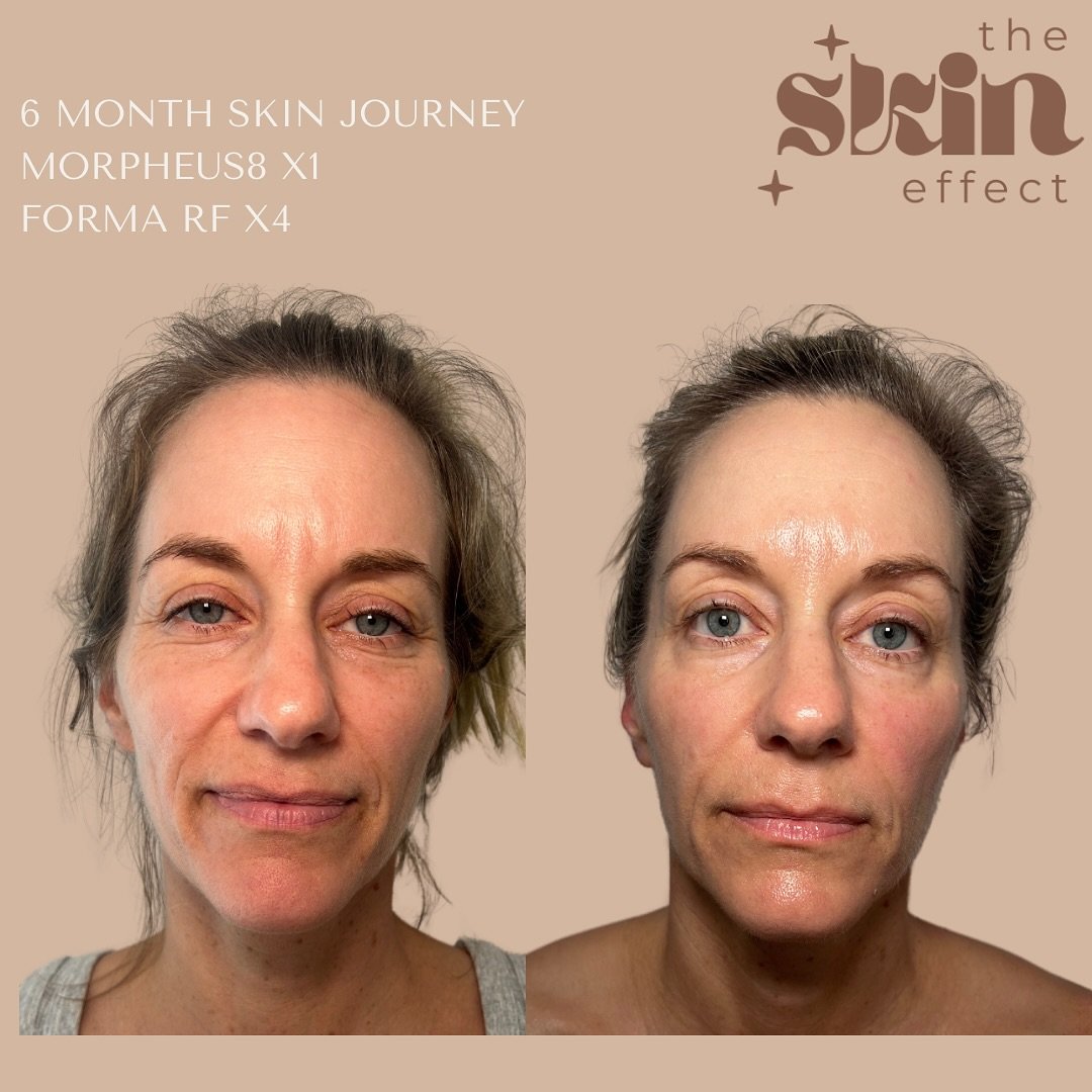 6 month skin health journey 🤩💆🏻&zwj;♀️

Rome wasn&rsquo;t built in a day and correcting skin concerns doesn&rsquo;t happen in a single session. Yes, we can get amazing results in just 1 single session, but real results are cumulative and progressi