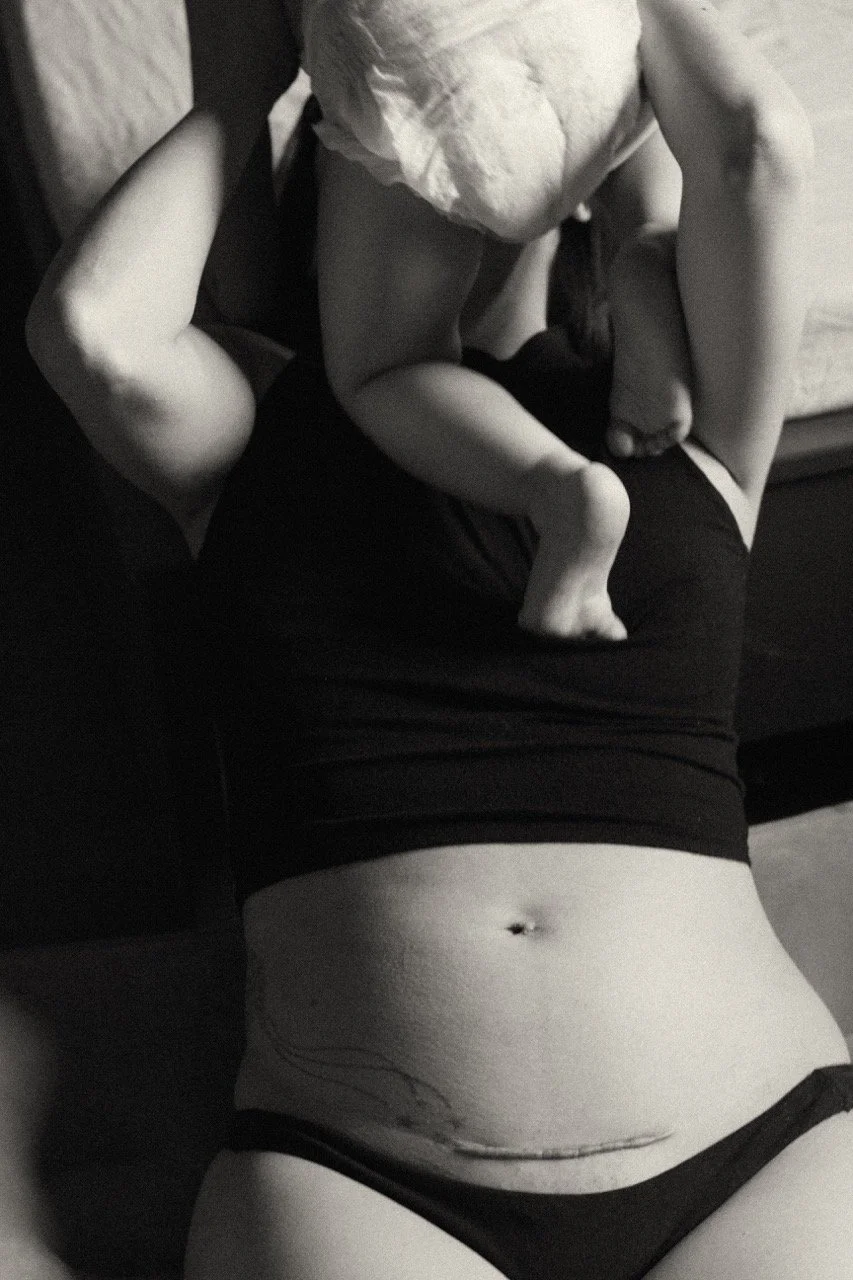 A close-up artistic study of a c-section scar, honoring the strength and physical sacrifice of birth. featured on Photo Vogue