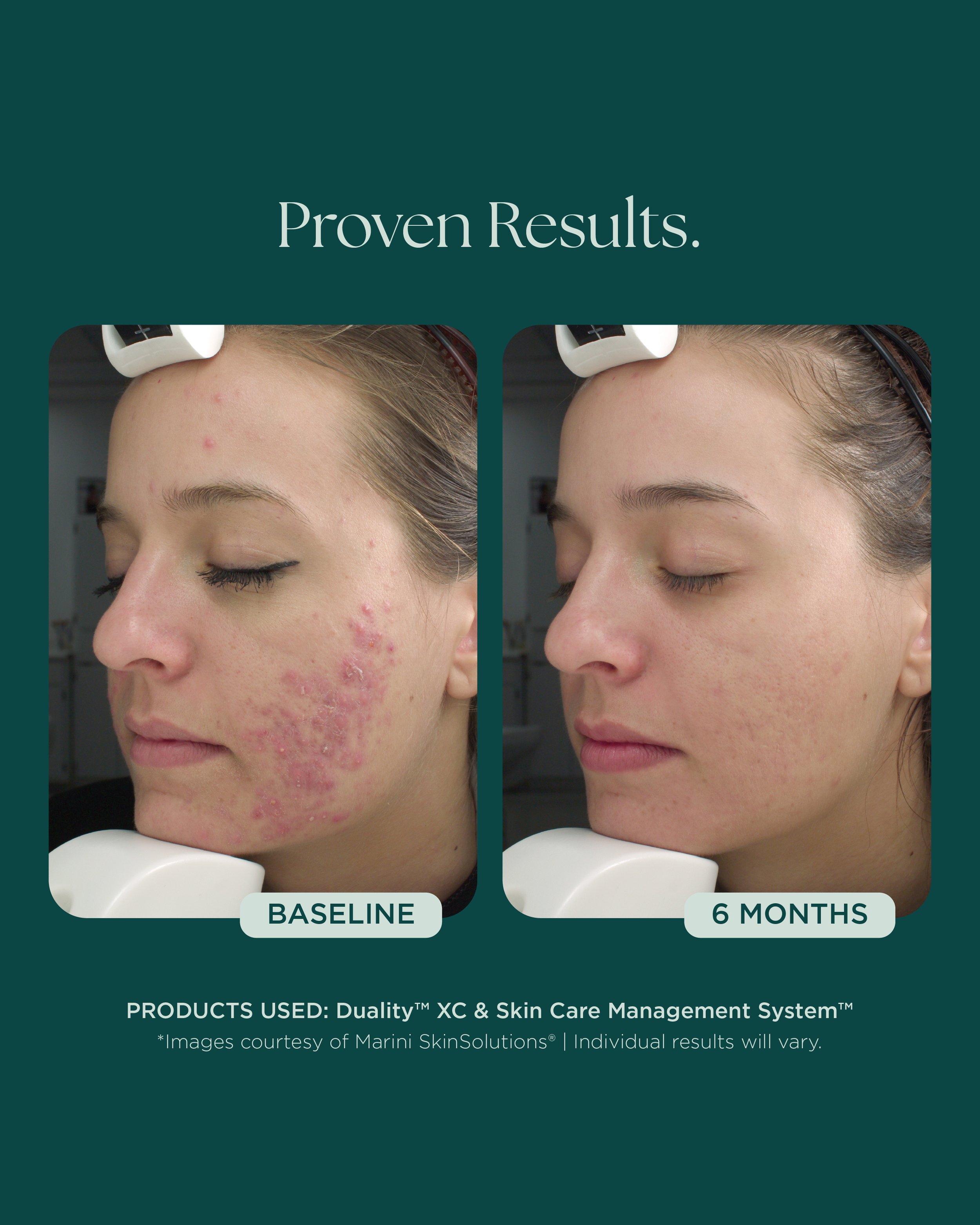 MSS26_Social_Before&Afters_ACNE_052826__ACNE-8028 (1).jpg