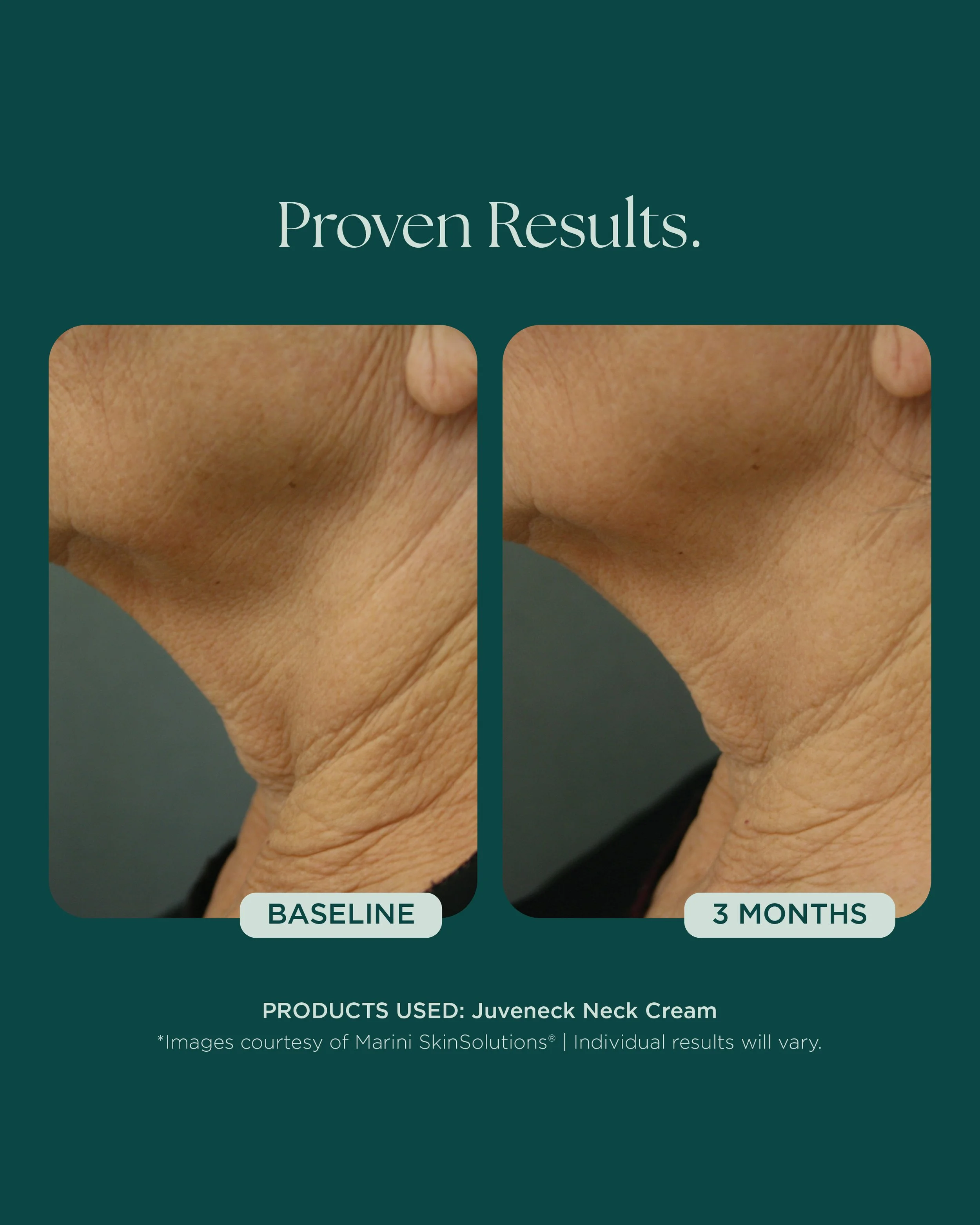 MSS26_Social_Before&Afters_BODY-NECK-EYES-HANDS_052826__NECK-Juvenck-1.jpg