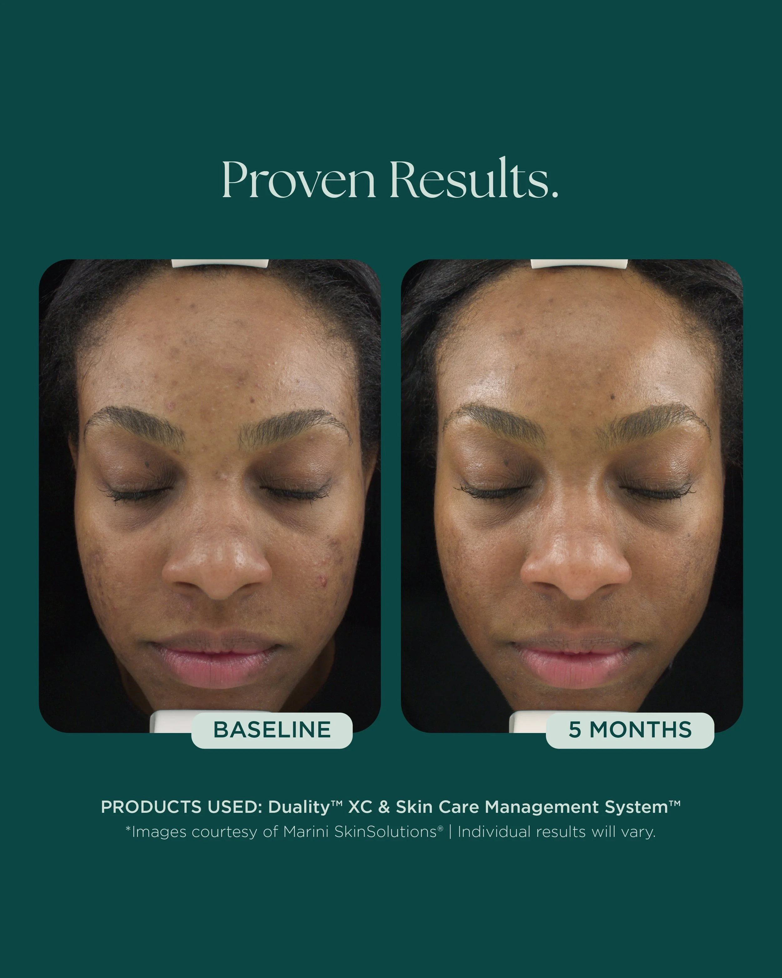 MSS26_Social_Before&Afters_ACNE_052826__ACNE-DualityXC (1).jpg