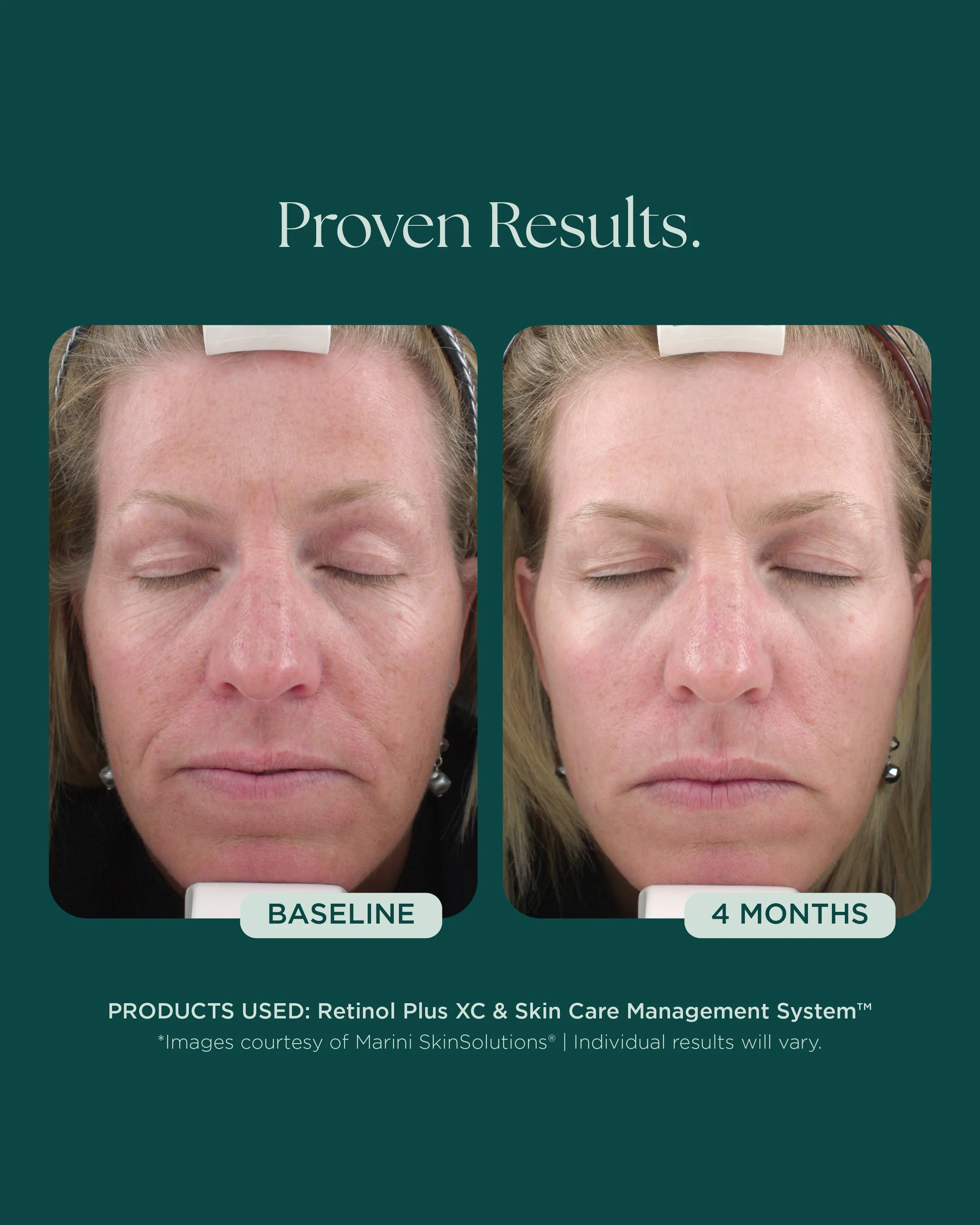 MSS26_Social_Before&Afters_FineLines+Wrinkles_052826__WRINKLES-8002 (1).jpg