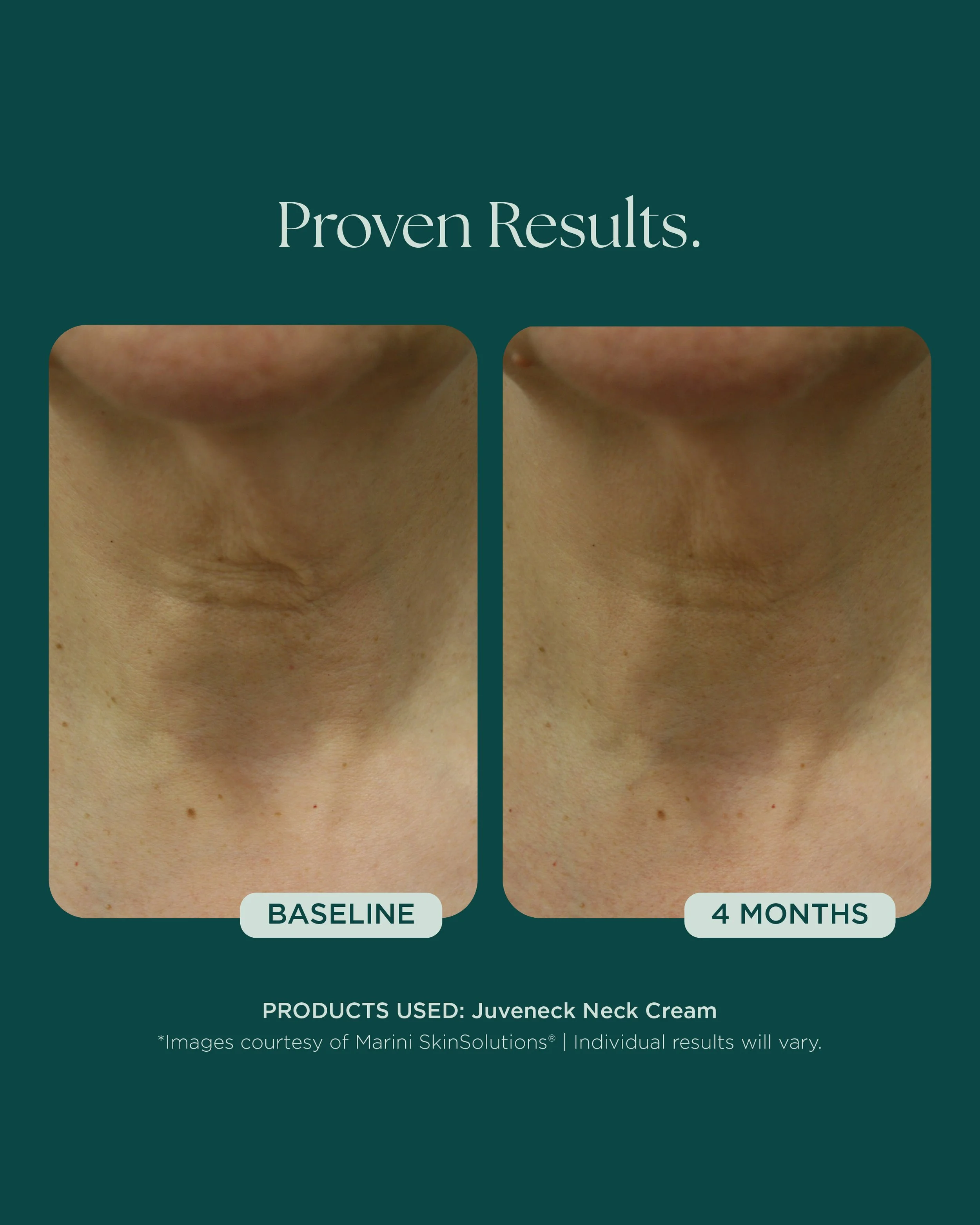 MSS26_Social_Before&Afters_BODY-NECK-EYES-HANDS_052826__NECK-Juvenck-3.jpg