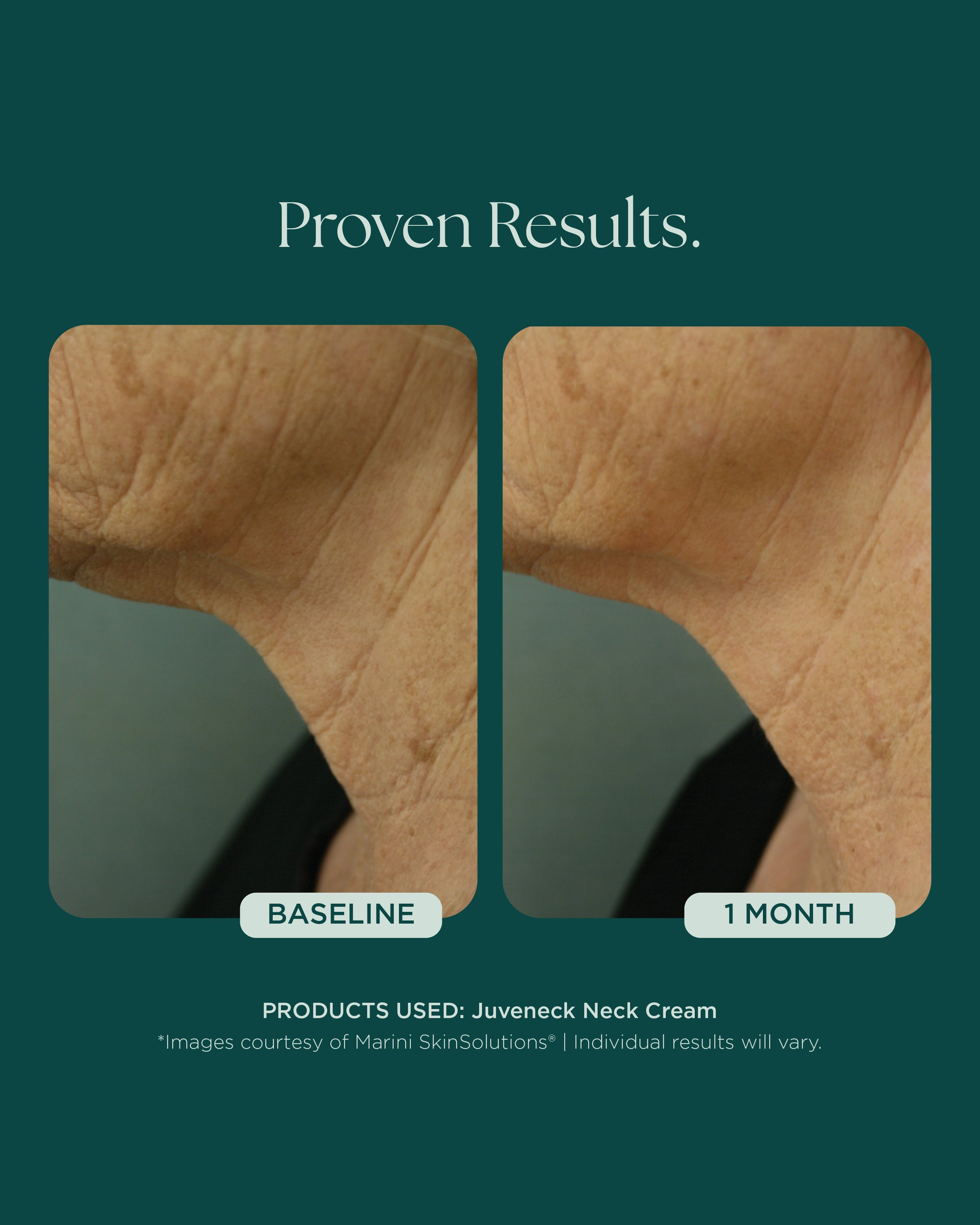 MSS26_Social_Before&Afters_BODY-NECK-EYES-HANDS_052826__NECK-Juvenck-2.jpg