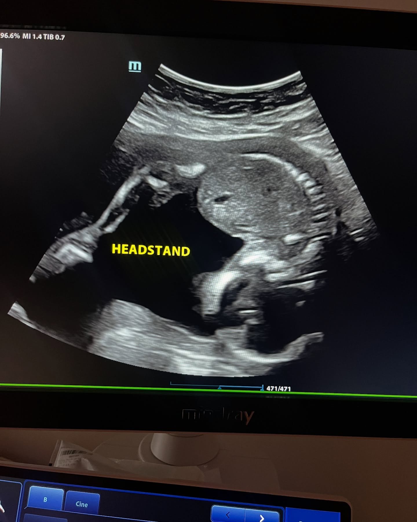 This precious 🌈 baby deserves a permanent spot on our feed! She was showing off during her anatomy scan for mom and dad! Look at that perfect headstand!
#pregnancy #3d4dultrasound #fortworthmoms #ftw #ultrasound #dfw #momsofinstagram #kellermoms #so