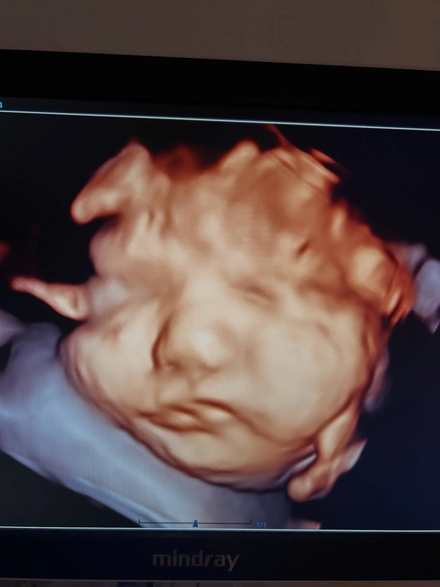 Cheeks for dayyyyssssss #chubbycheeks #babyontheway❤️ #fortworth #3d4dultrasound