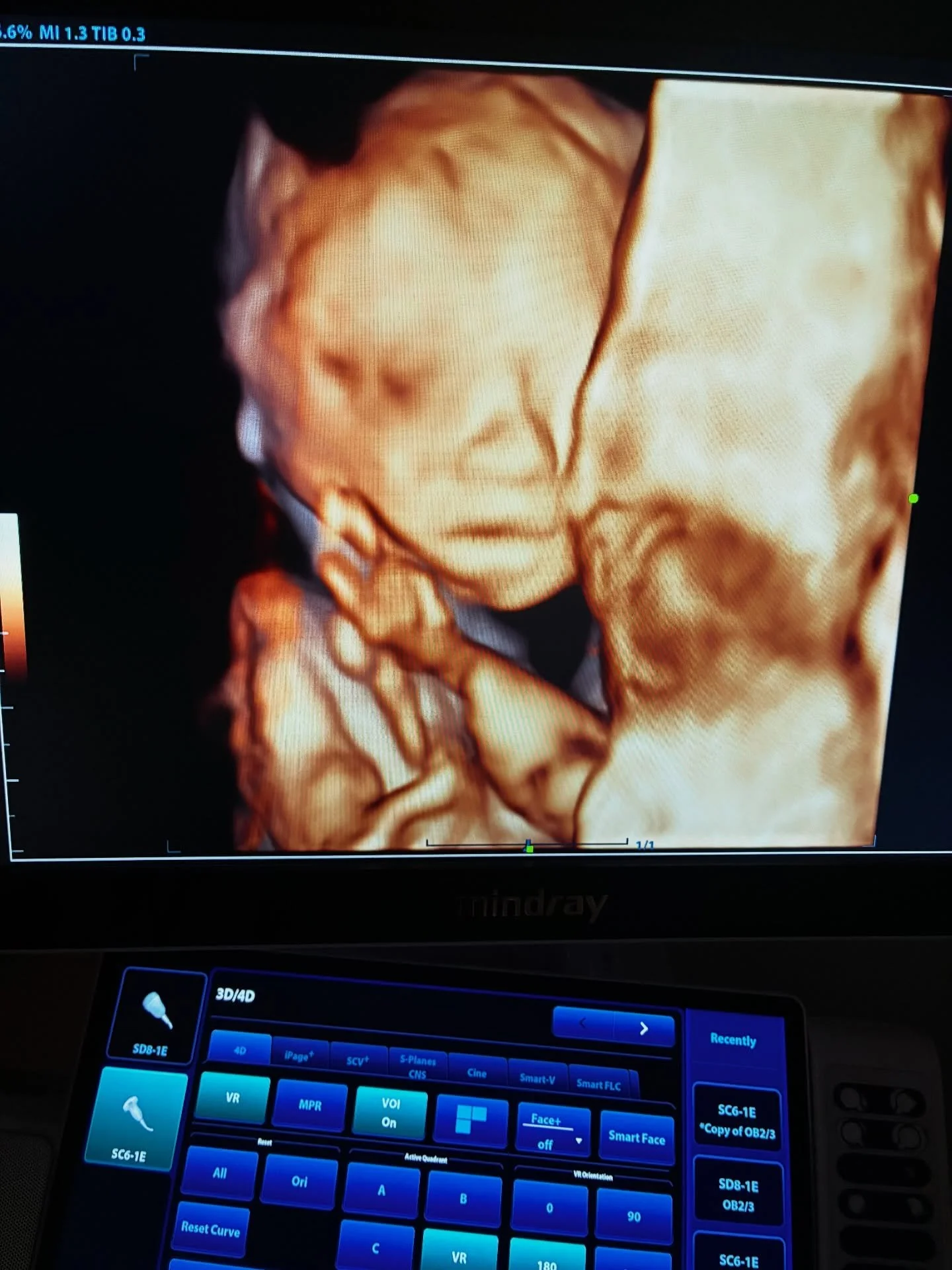 This baby is 1 pound at the anatomy scan. 😍