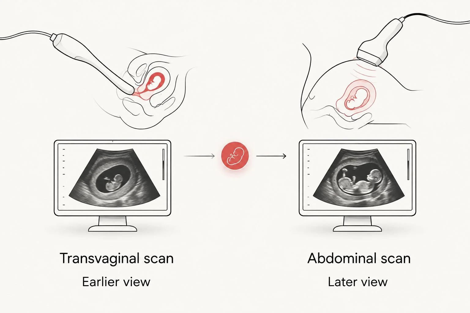 Comparison of transvaginal and abdominal ultrasound views in early pregnancy