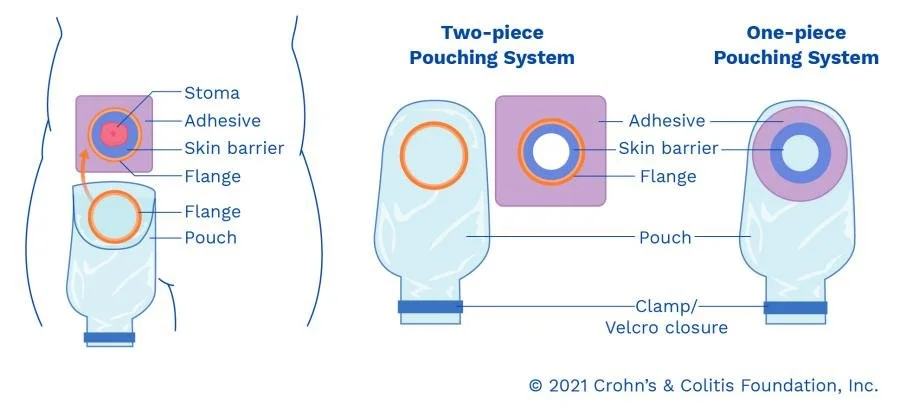 ostomy bag