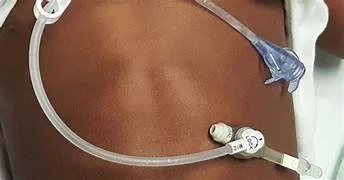 gj-tube