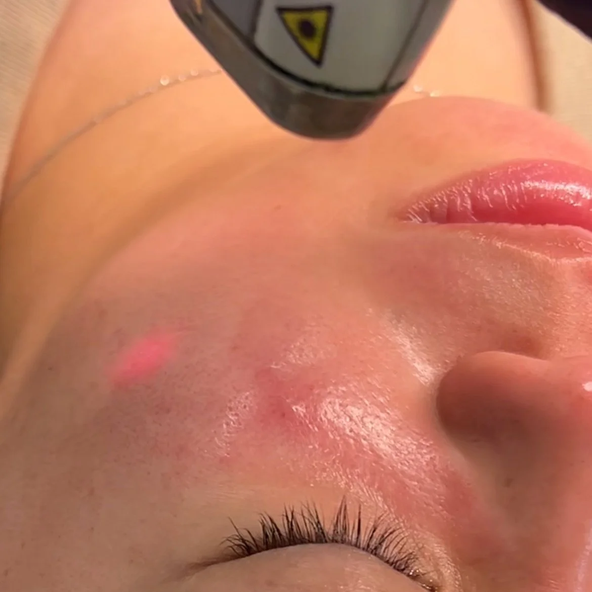 LASER GENESIS is a non-invasive laser that uses technology to gently heat the upper layer of the skin through distributing laser energy over thousands of micro pulses. The gentle heat stimulates collagen regrowth and gives a beautiful glow to the ski