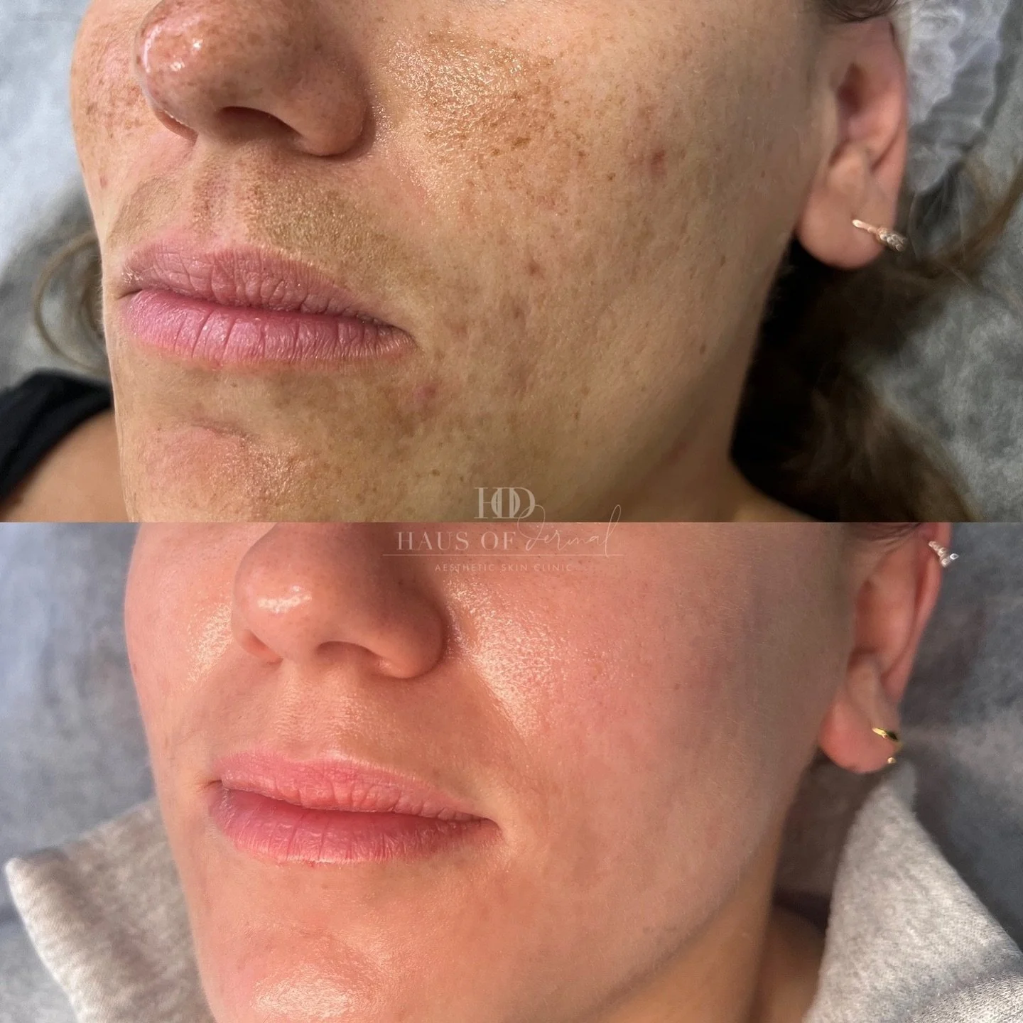 THYROID DYSFUNCTION &amp; MELASMA 

Melasma is a condition that causes brown or grey patches on the face. You will typically find this on the cheeks, forehead, nose and upper lips. It is believed to be linked to hormonal changes in the body, particul