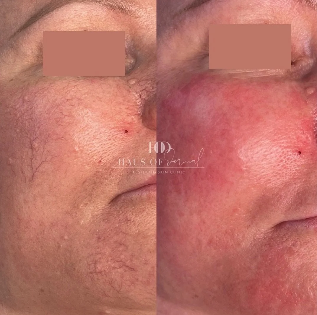 Broken capillaries, also known as telangiectasia, occur commonly on the cheeks, nose and chin in people with fairer skin types. Anything that heats up the body such as alcohol, hot showers, sun exposure or eating spicy foods can cause them to flush a