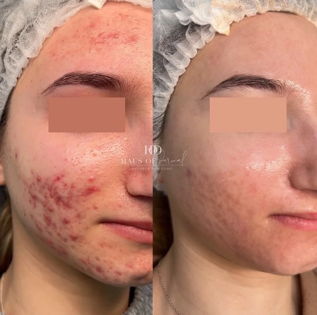 What an incredible improvement in just 3.5 months! 🫶🏽

We aren&rsquo;t at the finish line yet but she is looking AMAZING 🤩 It is now time to focus on post-inflammatory erythema (red marks) and scarring! 

Healing acne is not linear. You will have 