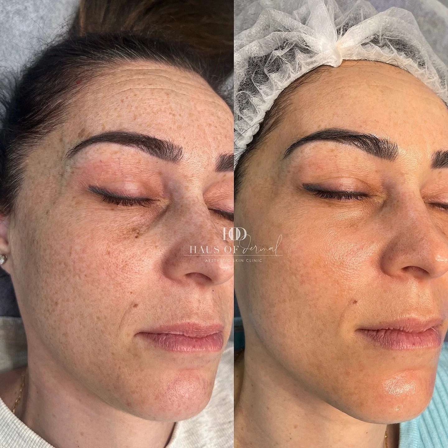Pigmentation is life long maintenance &mdash; I don&rsquo;t know how much I can stress this enough! There is no miracle treatment, no miracle product and if you aren&rsquo;t willing to put in the work. Well then, don&rsquo;t even waste your time / mo