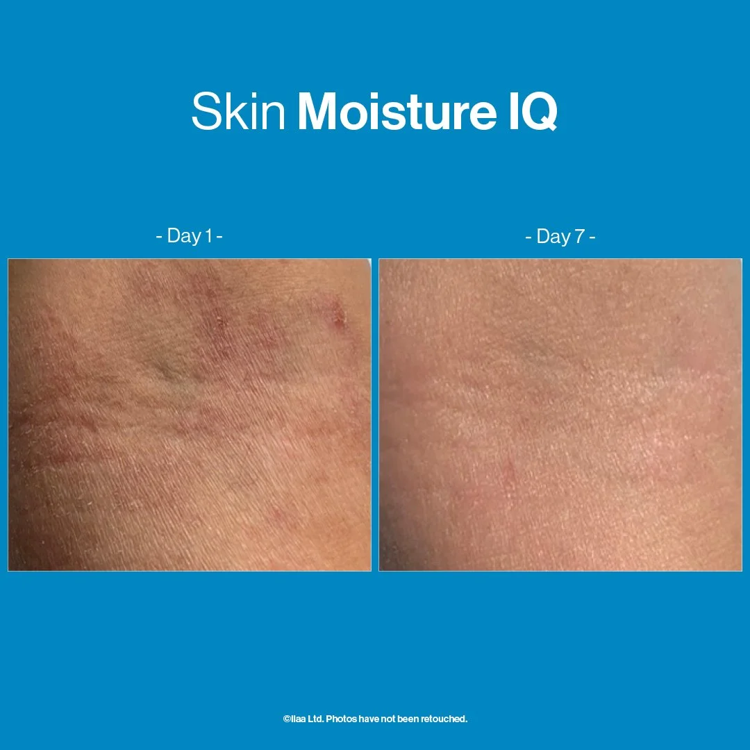 Advanced-Nutrition-Programme-Case-Study-Results_Social-Media-Skin-Moisture-IQ-1-Comparison.jpg