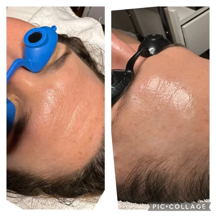 Procell treatment before and after