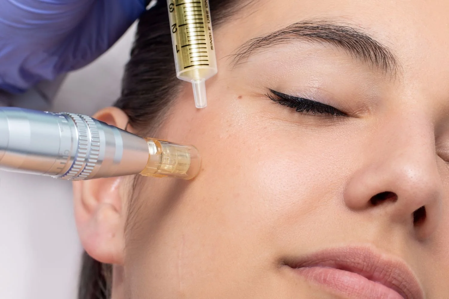 Close-up of a microneedling treatment on the cheek