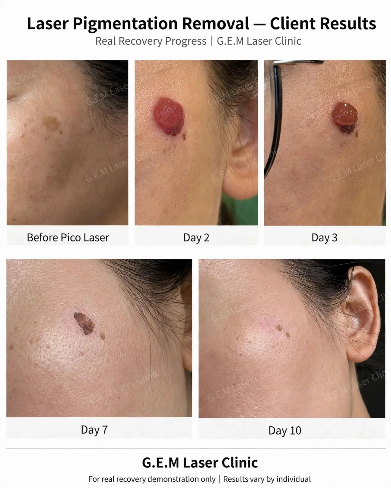 Pico laser pigmentation removal recovery progress, before to day 10, at G.E.M Laser Clinic Markham
