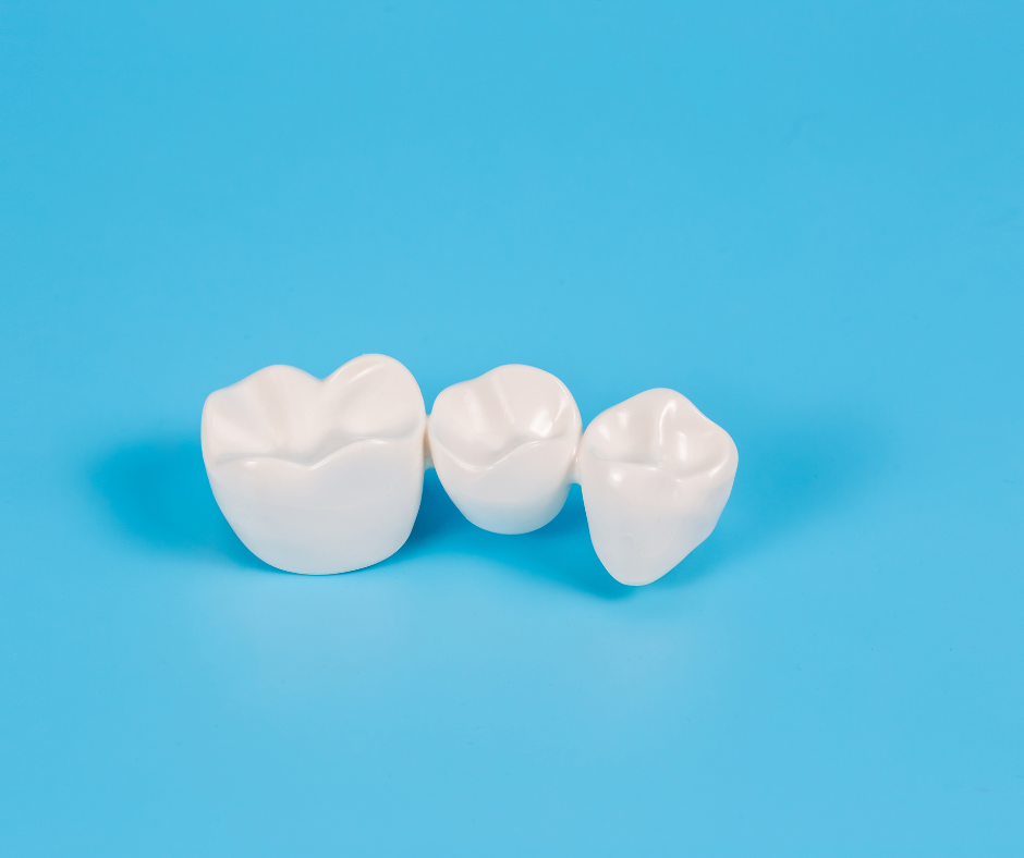 Porcelain Fixed Bridges