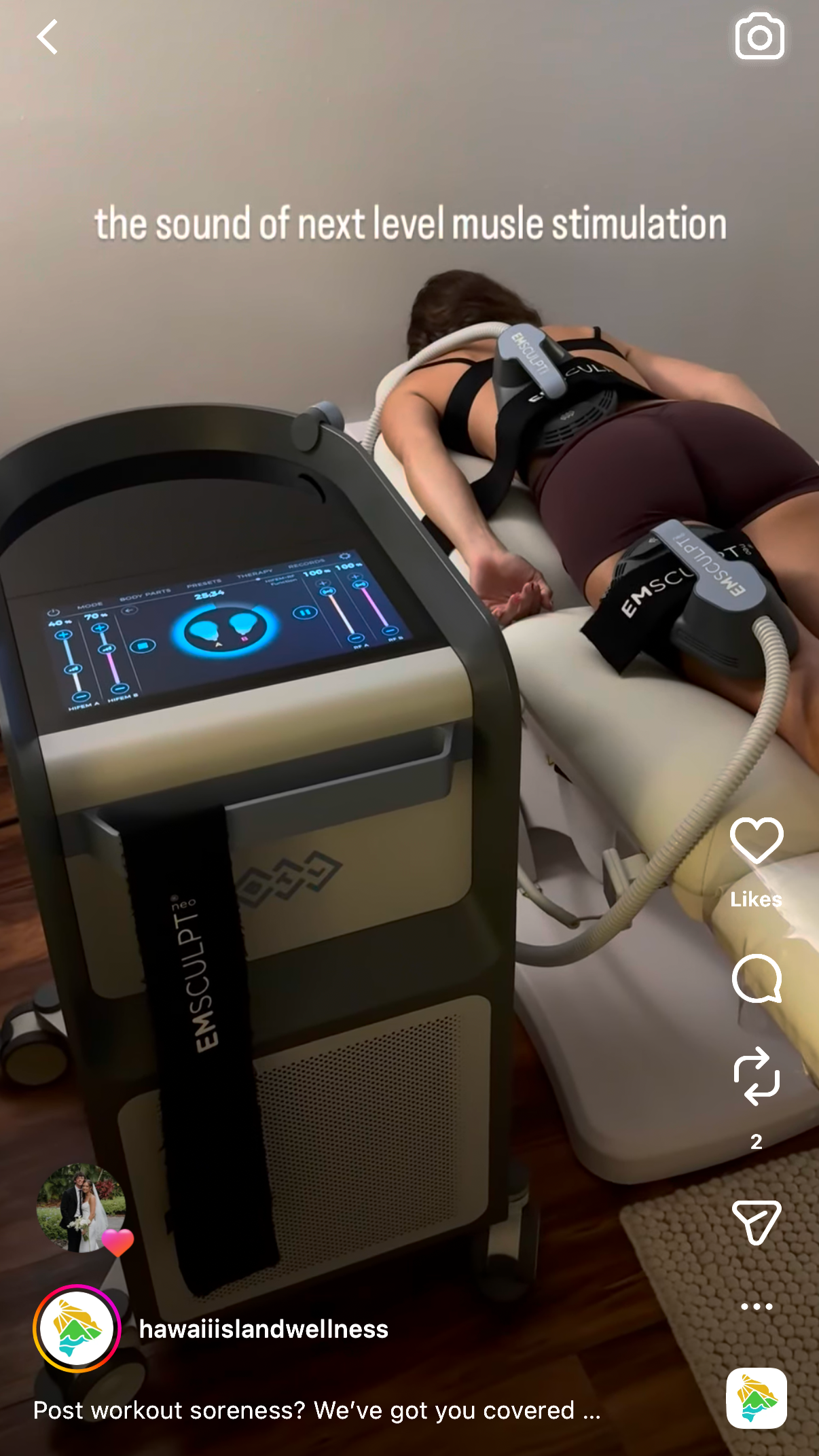 A woman receiving a muscle stimulation treatment with a device labeled EMSCULPT near her thighs and abdomen, lying on a treatment bed. The device displays control screens with blue and pink bars and sliders.