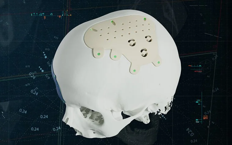materialise-cmf-solutions-personalized peek-implants.jpg