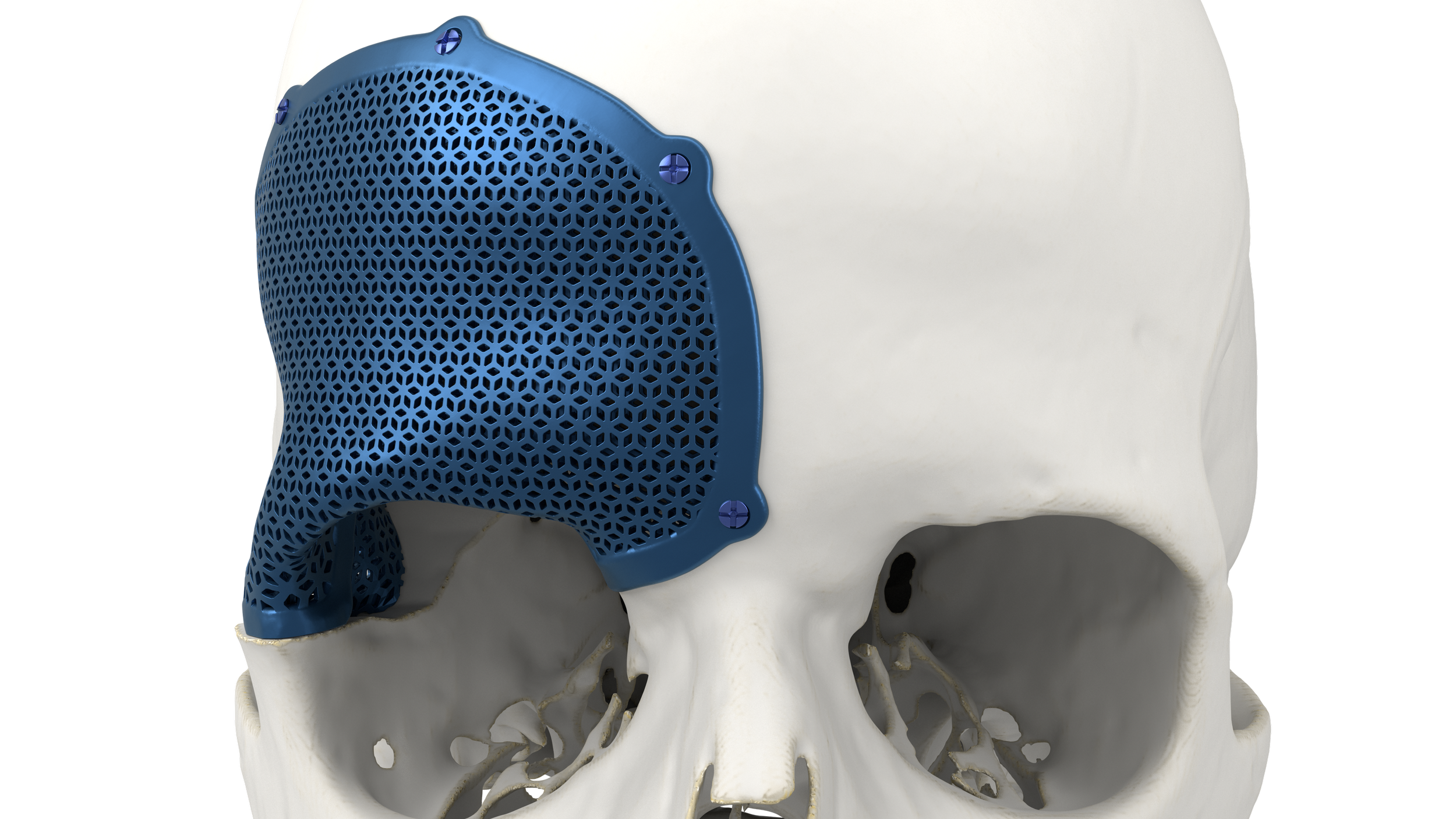 3D printed implant.png